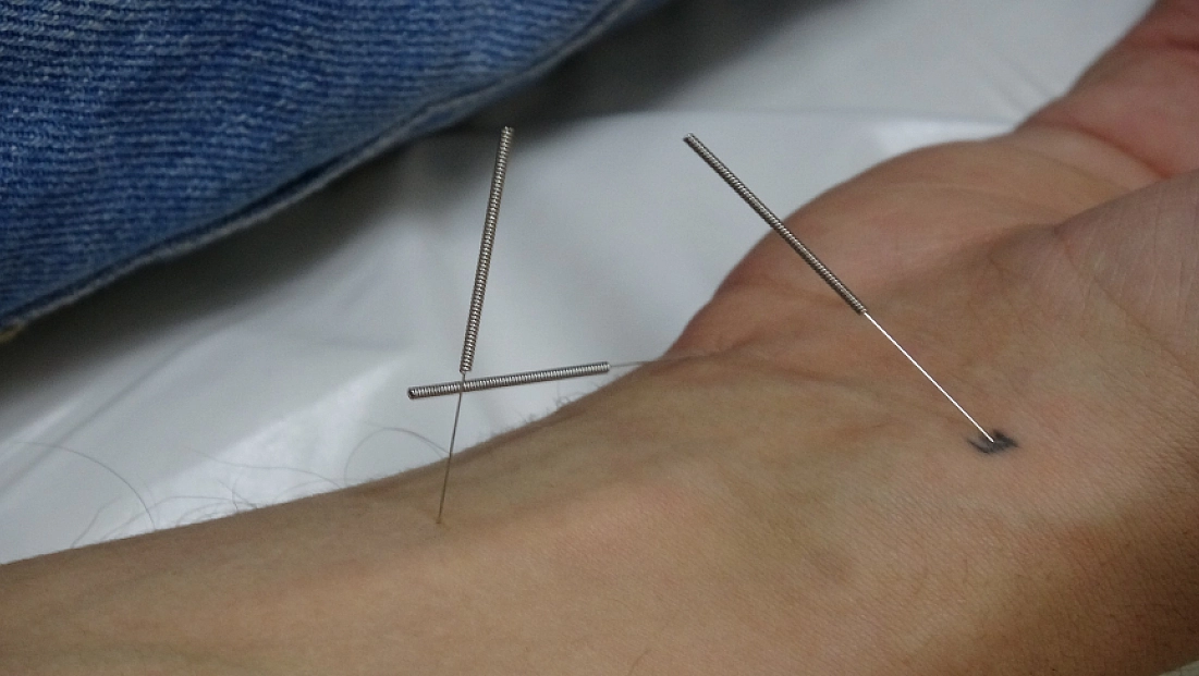 Akupunktur tedavisiyle sağlıklarına kavuştular