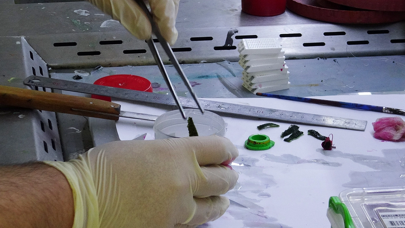 Patolojiye Giden Her Örnek Kanser mi? İşte Korkutan O Yanlış Algı!