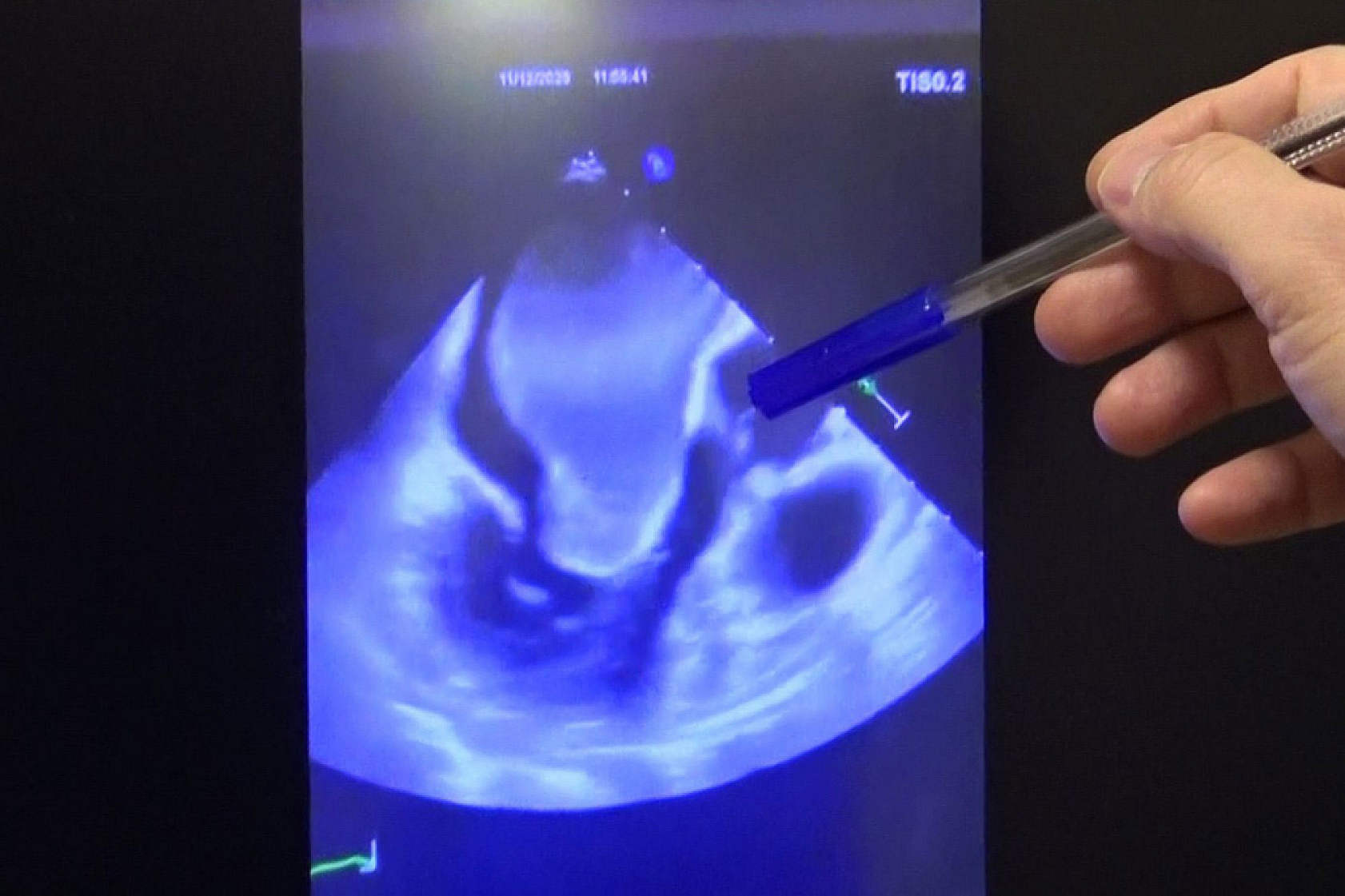 Malatya'da tıp tarihine geçen operasyon: Kalbin içindeki dev kitle alındı