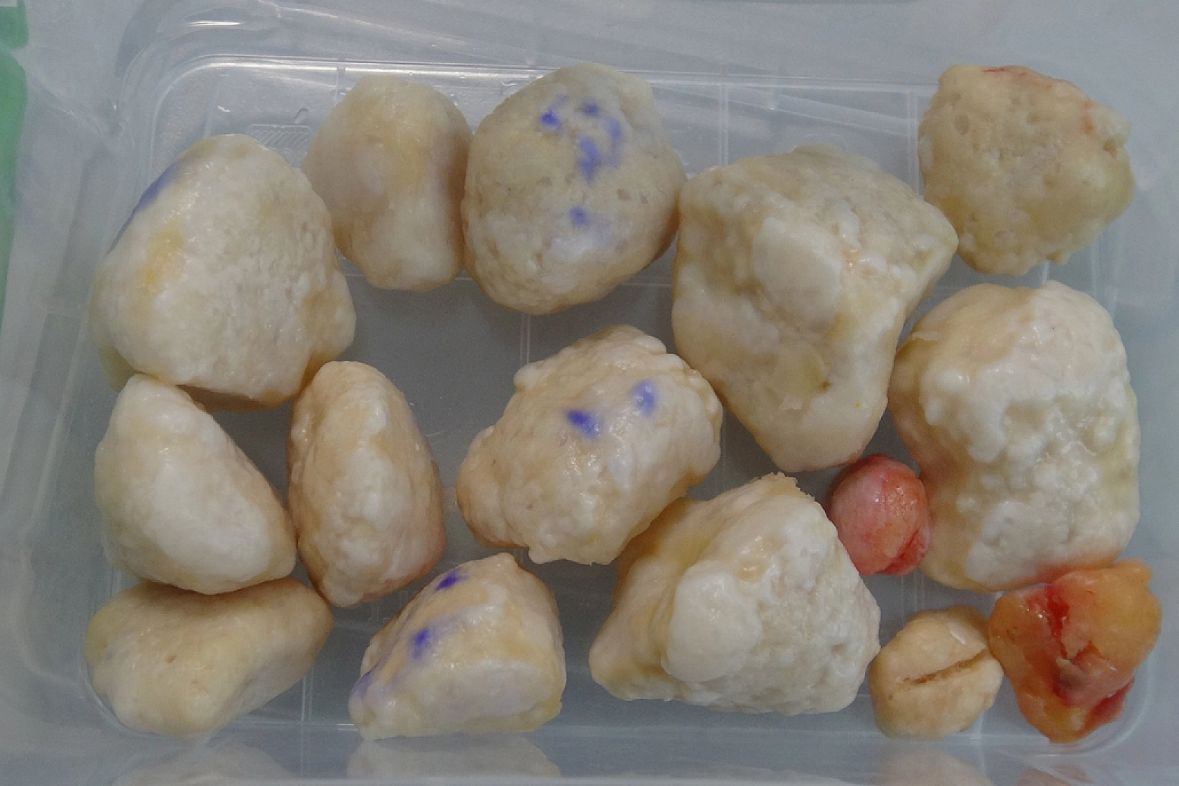 Dizinde taşlaşmış 24 kitleyle 15 yıl yaşadı! Aynı anda iki ameliyat oldu…