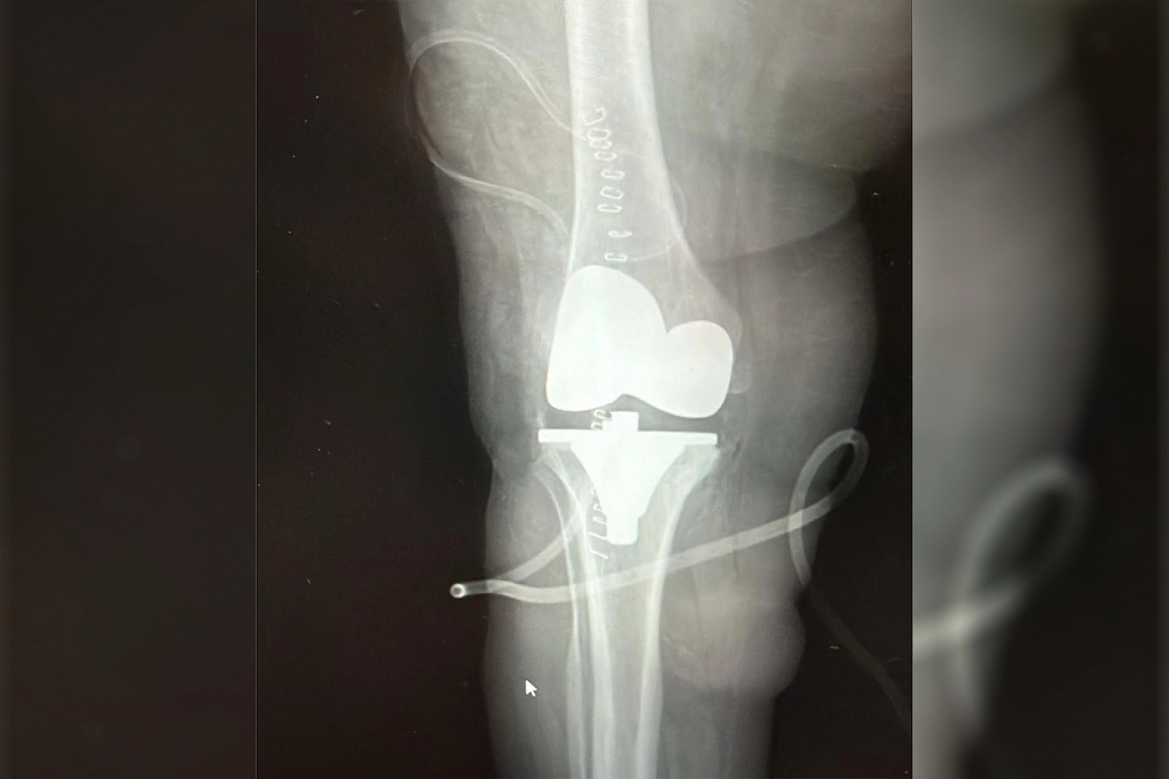 Dizinde taşlaşmış 24 kitleyle 15 yıl yaşadı! Aynı anda iki ameliyat oldu…