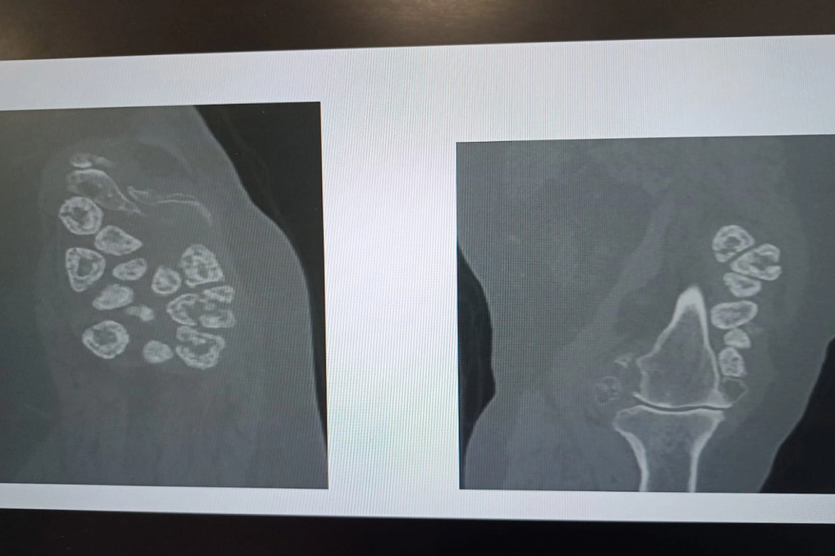 Dizinde taşlaşmış 24 kitleyle 15 yıl yaşadı! Aynı anda iki ameliyat oldu…