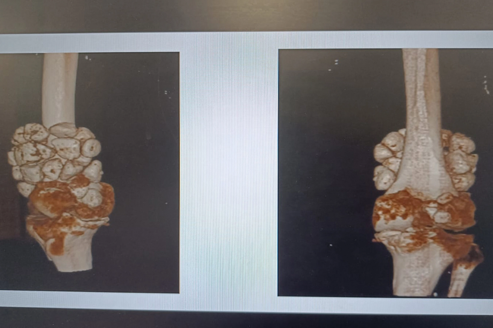 Dizinde taşlaşmış 24 kitleyle 15 yıl yaşadı! Aynı anda iki ameliyat oldu…