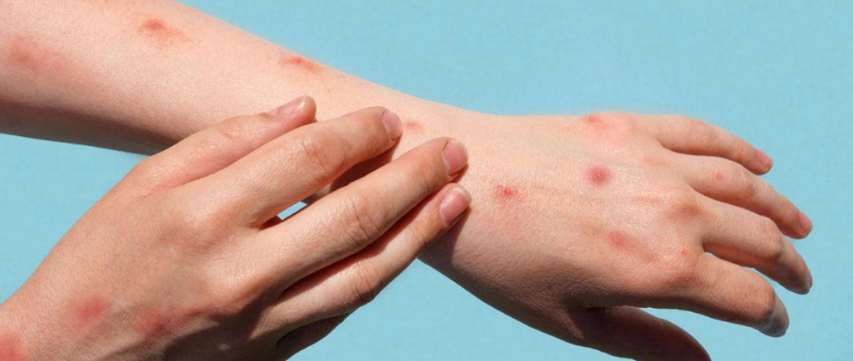 COVID-19 Sonrası Yeni Tehdit: Maymun Çiçeği Virüsü!