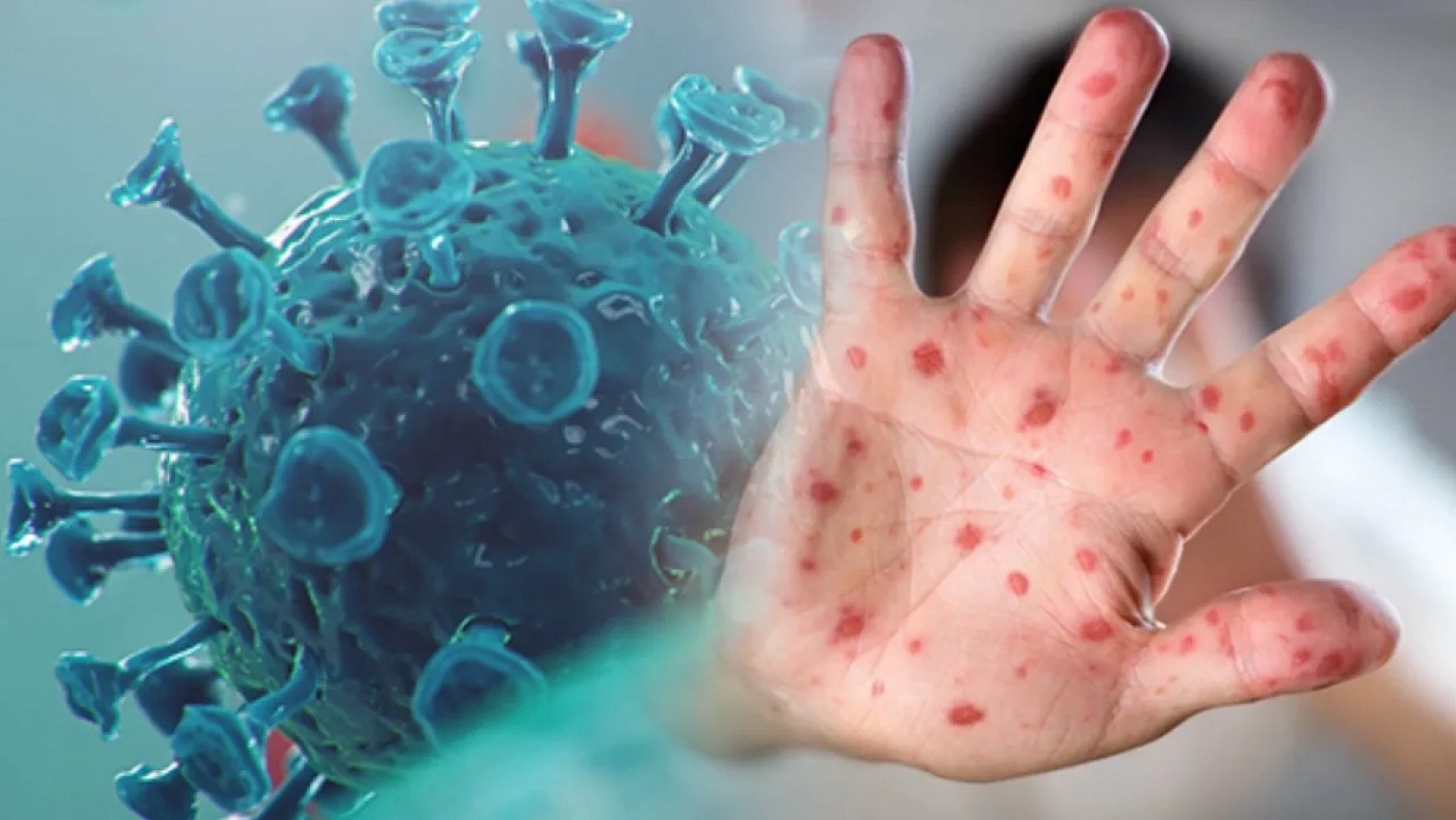 COVID-19 Sonrası Yeni Tehdit: Maymun Çiçeği Virüsü!