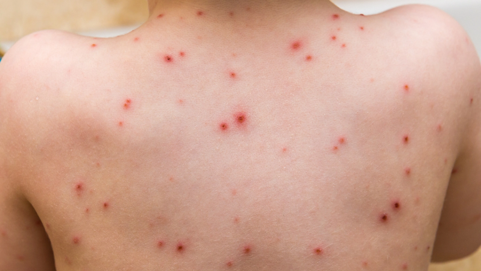 M-Çiçeği Virüsü Hakkında Merak Edilen Sorular ve Yanıtları...