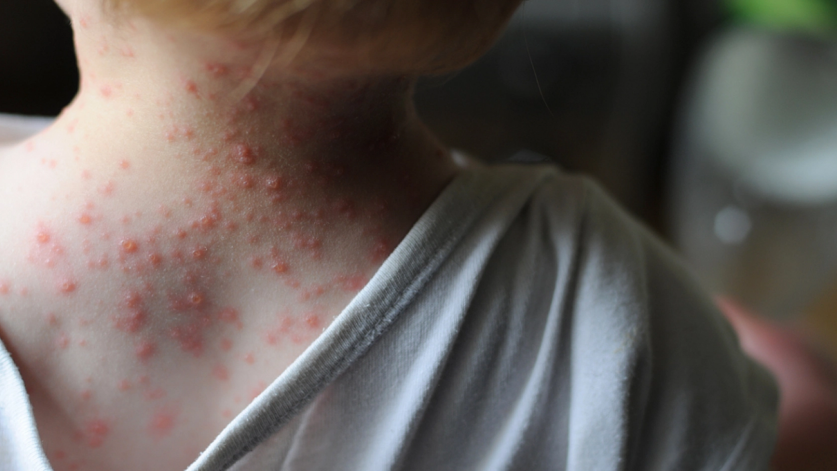 M-Çiçeği Virüsü Hakkında Merak Edilen Sorular ve Yanıtları...