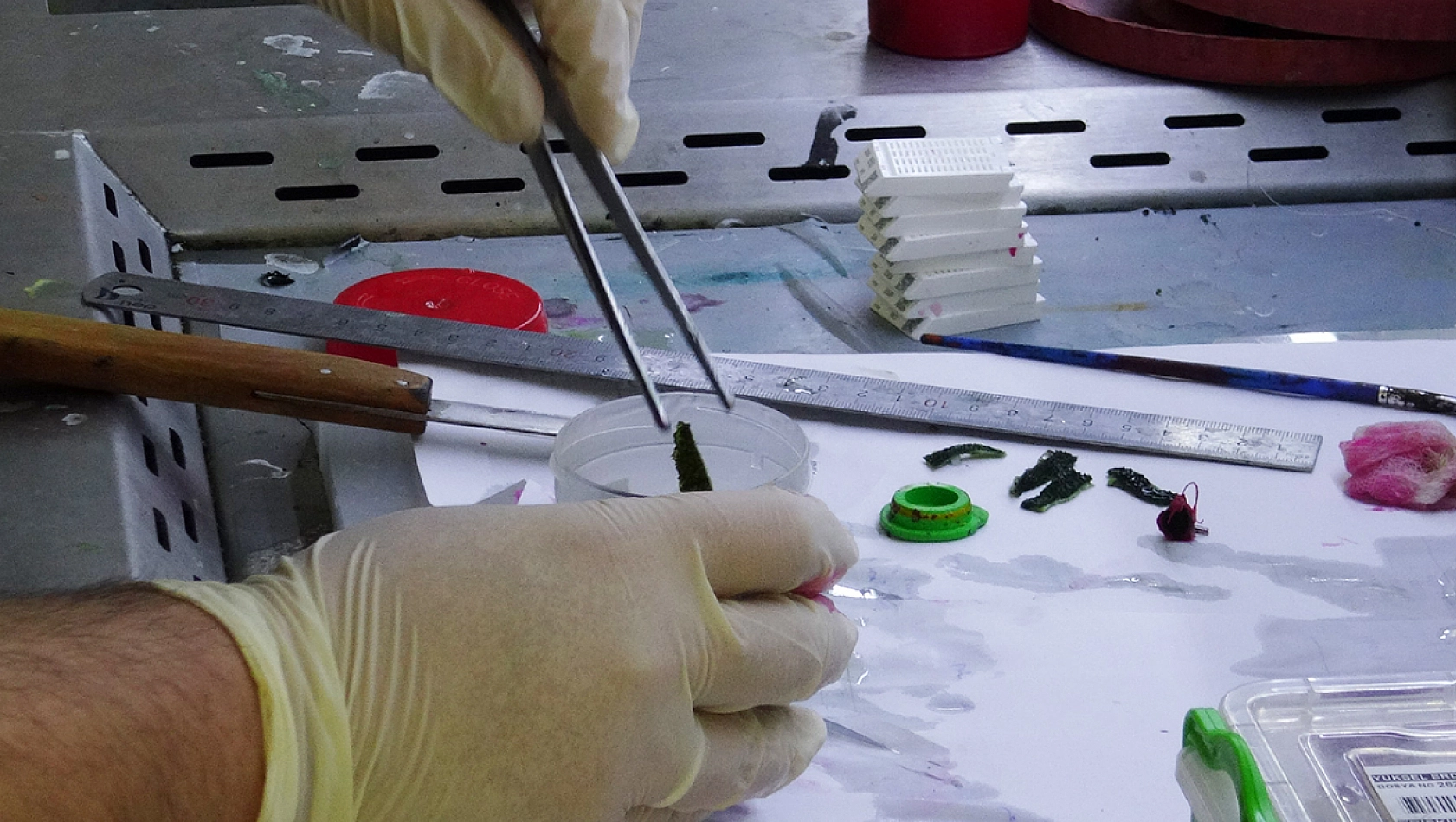 Patolojiye Giden Her Örnek Kanser mi? İşte Korkutan O Yanlış Algı!