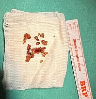 Burun estetiğinde nadir durum: Taş tespit edildi