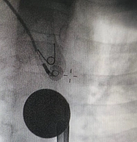 Boğazına madeni para kaçan çocuk kurtarıldı