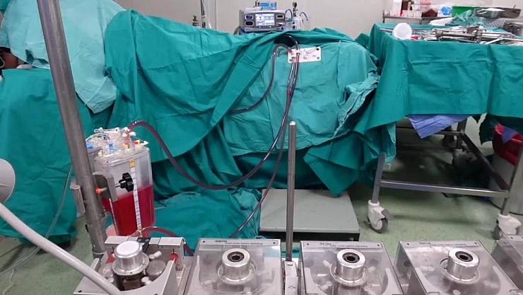 HIPEC yöntemi ile kanser tedavisi uygulanıyor