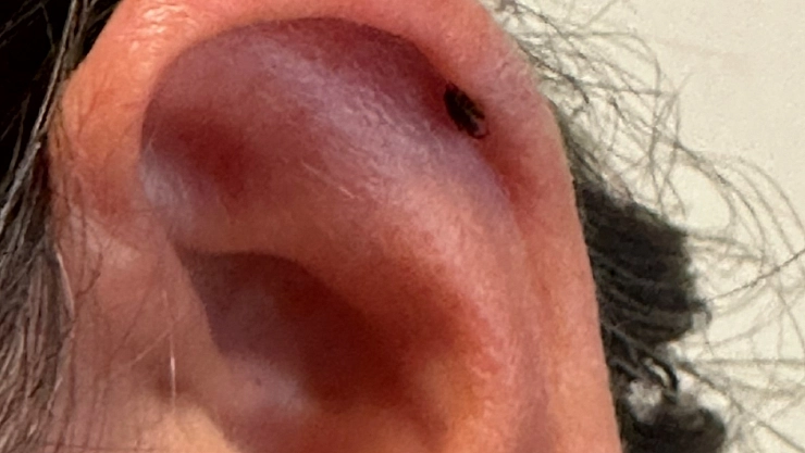 Kadının kulağını kene ısırdı