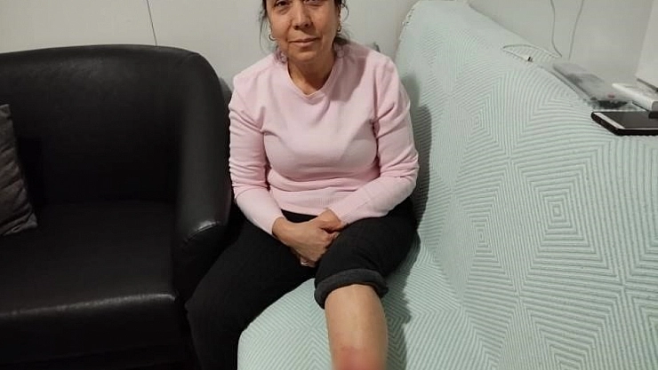 Köpek saldırısına uğradı bacağı ne hale geldi