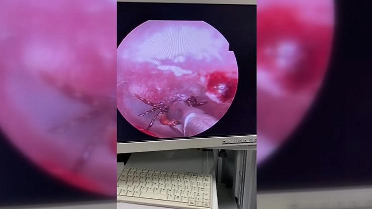 Kulak ağrısı dedi, bakın ne çıktı