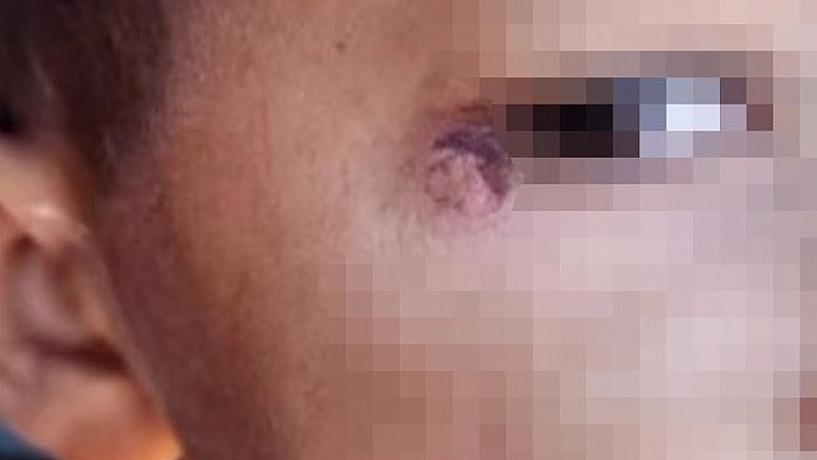 Öğrencinin yüzünde sigara söndüren temizlik görevlisi tutuklandı