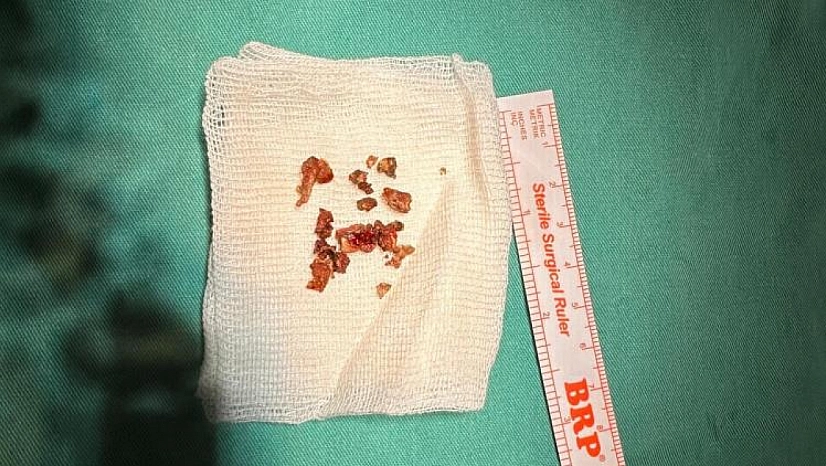 Burun estetiğinde nadir durum: Taş tespit edildi