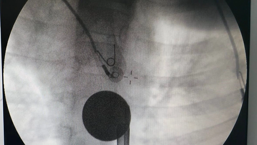 Boğazına madeni para kaçan çocuk kurtarıldı